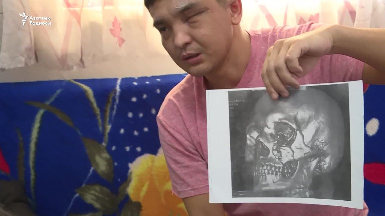 Жағы сынып, құлағына зақым келген, бір көзі көрмейді...